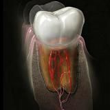 Endodontitis