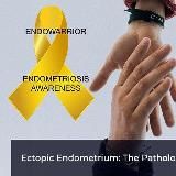 Про эндометриоз
