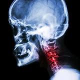 Шейный остеохондроз