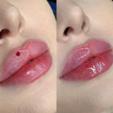 КОСМЕТОЛОГ КРАСНОДАР/ МОСКВА/УВЕЛИЧЕНИЕ ЯГОДИЦ/ГРУДИ