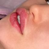 Увеличение губ • ilove_lips